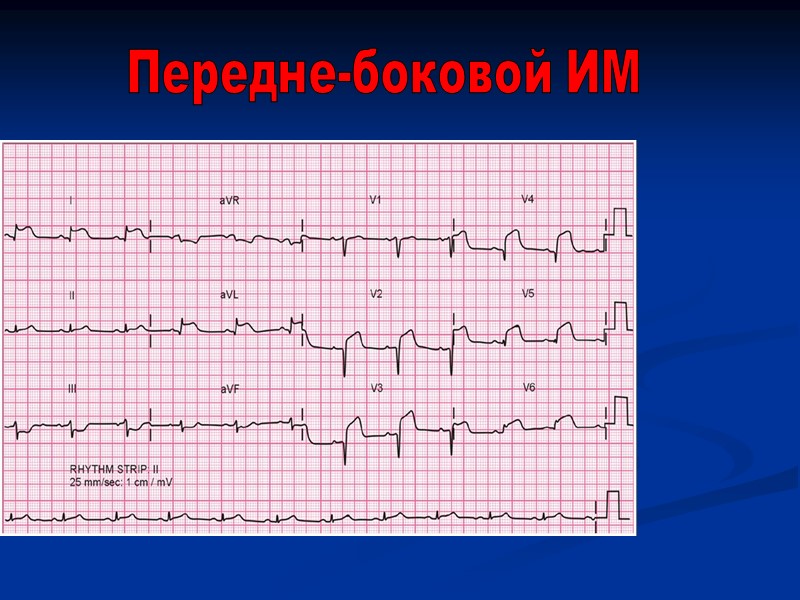 Передне-боковой ИМ